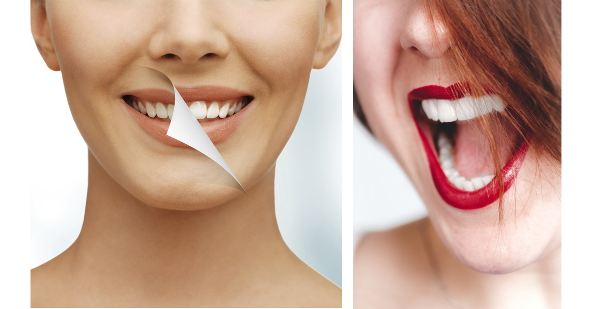 Smile Makeovers Επιλογές θεραπείας